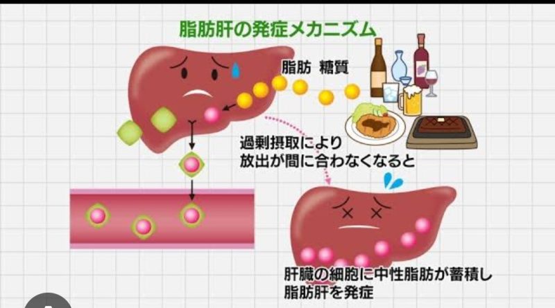 脂肪肝の仕組みを説明したイラスト